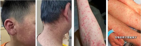 国家疾控局局长带队赶赴佛山